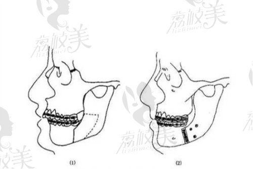 正頜手術示意圖