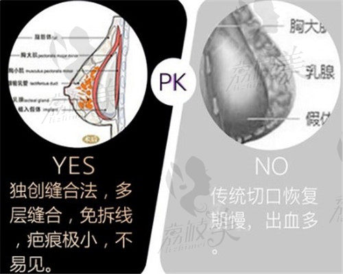 武汉美莱王洪胸部整形技术优势