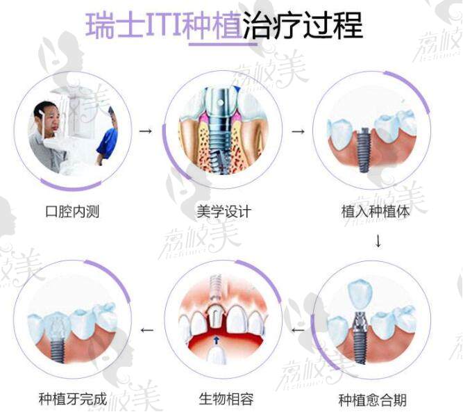 瑞士ITI种植治疗过程