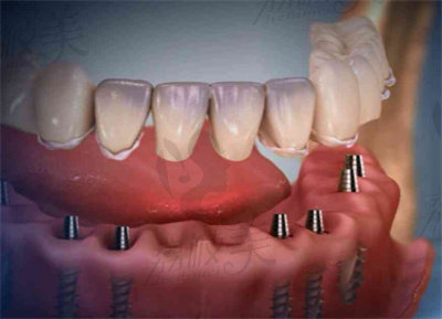 万诺口腔数字化种植牙的技术优势2