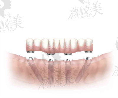 占小平医生种牙的技术优势2
