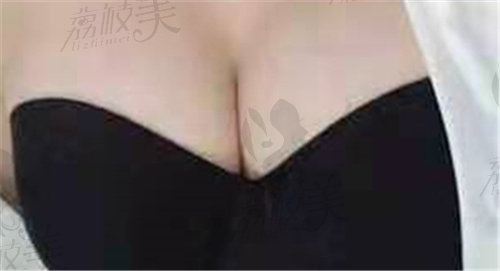 吴江山隆胸手术后图