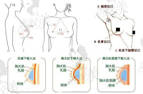 隆胸手术常用三种切口及假体植入方法