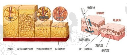 吸脂示意图