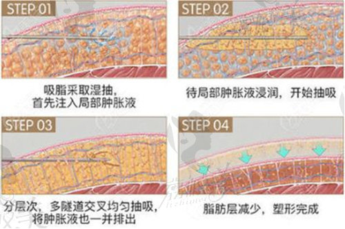 吸脂的过程