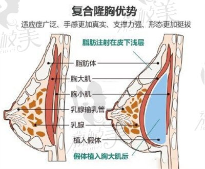 聶志宏隆胸優(yōu)勢