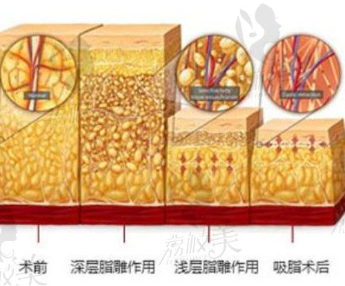 fse分層吸脂示意圖