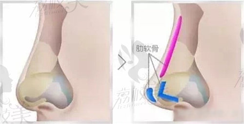 成都铜雀台医疗美容医院周柯院长提及的肋软骨安放地