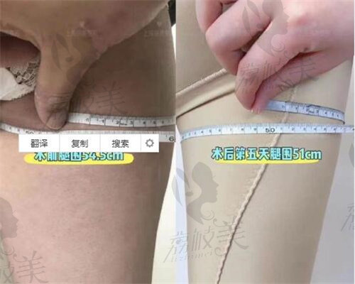 上海丽质吸脂前后腿围变化