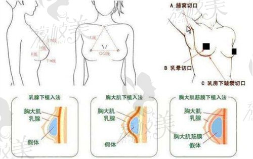 成都赵敬国医生胸部整形