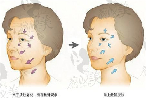 黄广香医生提及的面部提升部位