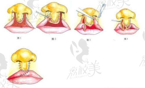 北京八大處唇腭裂修復(fù)示意圖