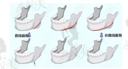 下颌角整形示意图