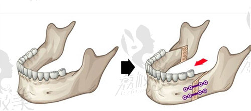 正颌手术示意图