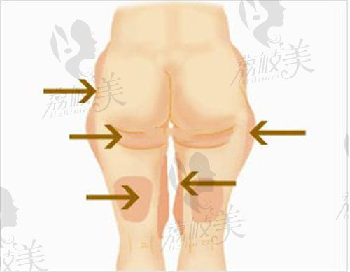 邓萌医生吸脂部分展示图