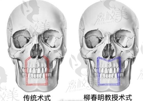 柳春明M形準(zhǔn)確截骨，勻梯度凸嘴手術(shù)術(shù)式