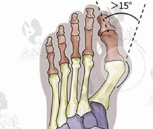 大腳骨拇外翻