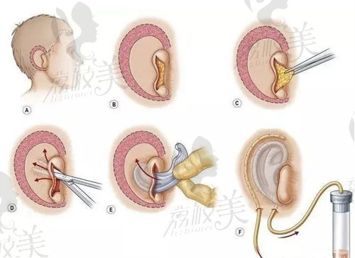 耳再造手术过程图
