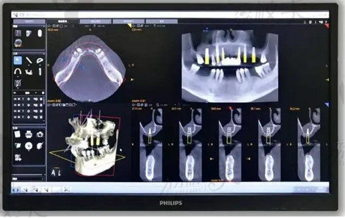 3D数字化导板种植牙