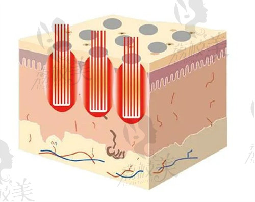 点阵激光作用在皮肤示意图