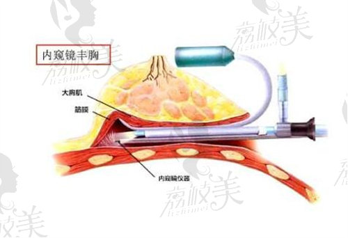 內(nèi)窺鏡豐胸演示