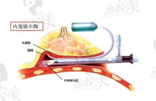 陈郇使用的内窥镜示意图