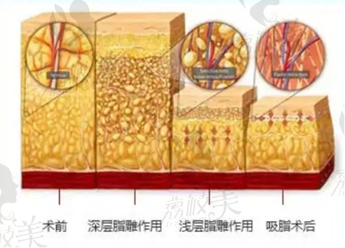 蒲小兵吸脂示意图