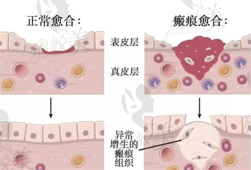 瘢痕的形成