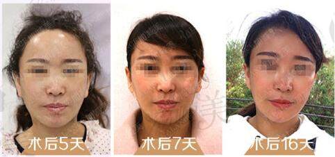 北京加减美面部提升术后