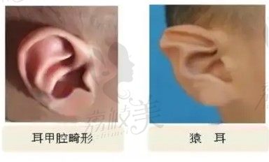 耳朵畸形图
