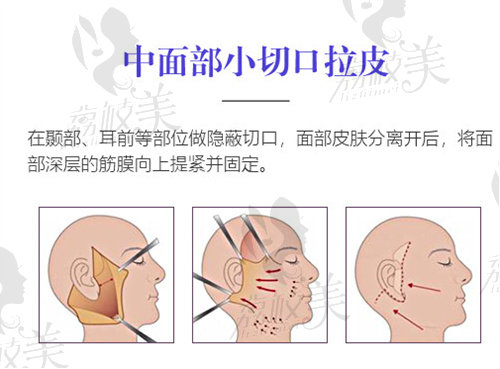 李青峰中小面部小切口拉皮