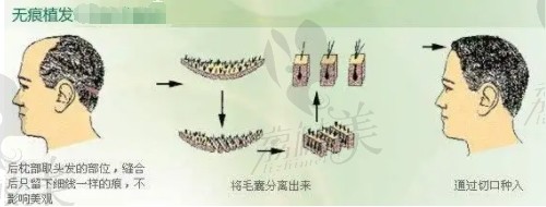 无痕植发图解