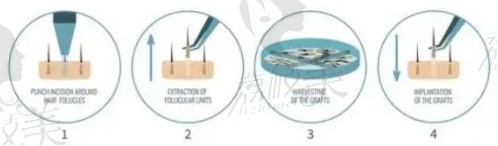 无痕植发原理