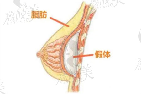 夏家军假体丰胸技术实力强