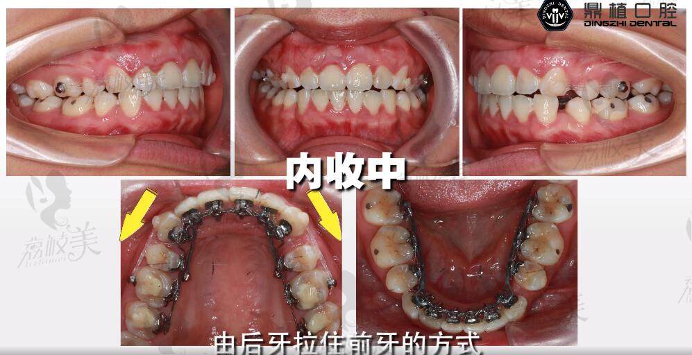 上海鼎植口腔牙齿矫正