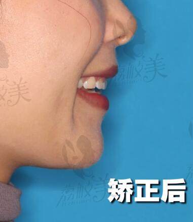 上海鼎植口腔于迪医生舌侧矫正术后