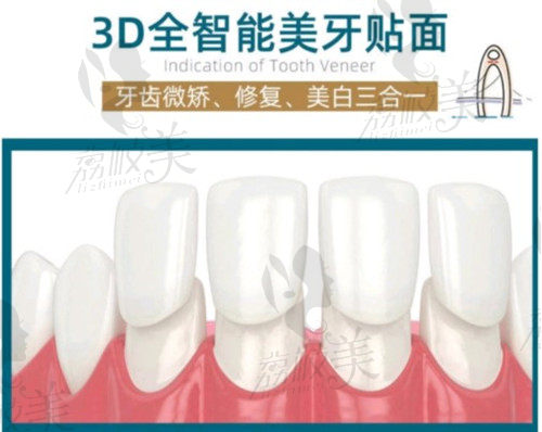 廣州家庭醫(yī)生牙貼面