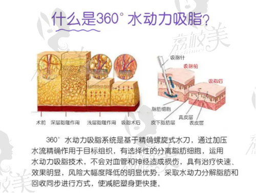 郭光烨医生说的水动力吸脂