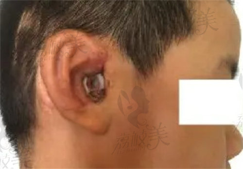 二期耳再造手术后