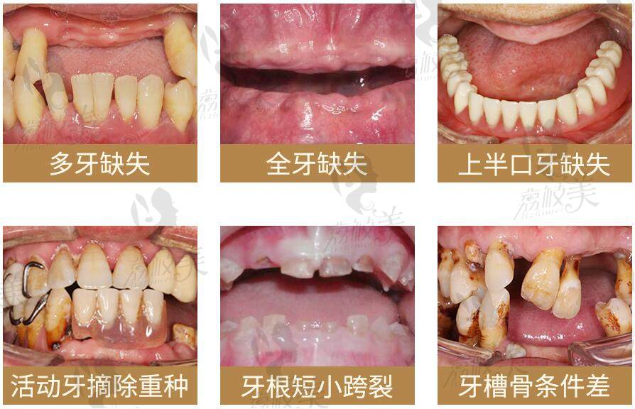 牙齿缺失的各种表现