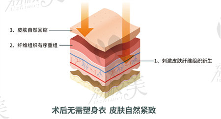 土麦森吸脂优势