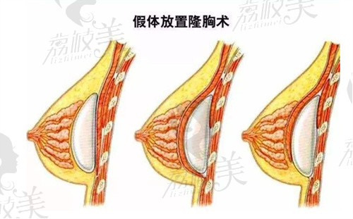 徐少駿醫(yī)生說的假體放置三種方法