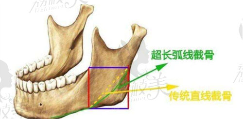 南寧愛思特整形長(zhǎng)曲線截骨