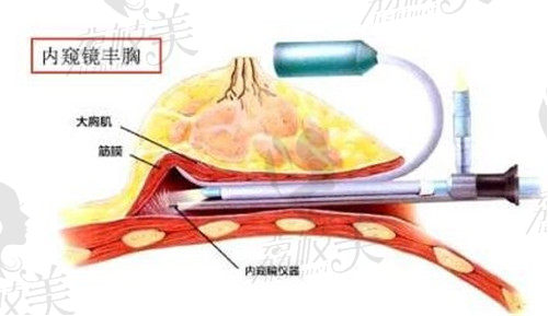 长沙丽都内窥镜隆胸