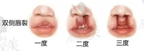 双侧唇裂分度