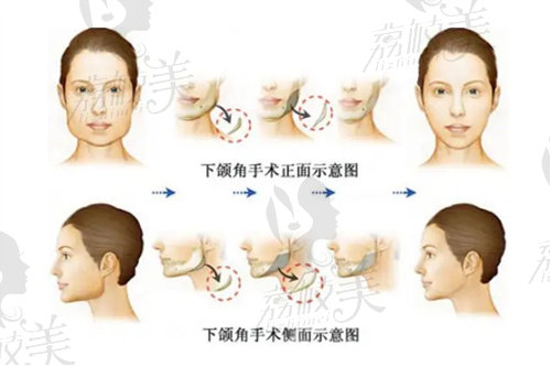 下頜角整形示意圖