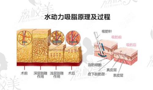 郭光烨医生所说的水动力吸脂