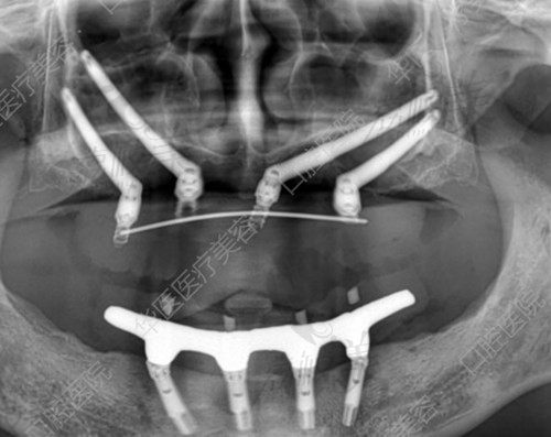 呼和浩特華醫(yī)口腔醫(yī)院全口種植牙