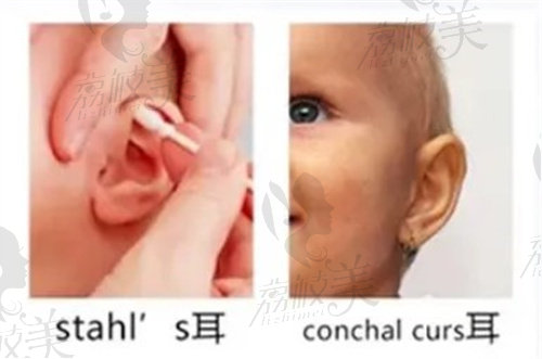 Stahl‘s耳和conchal curs耳