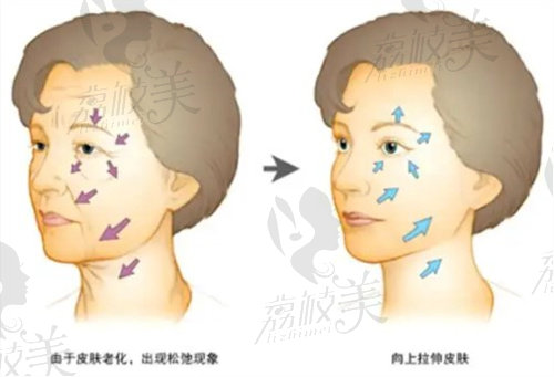 面部提升示意图